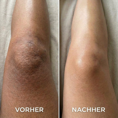 Kojisäure-Kurkuma-Sprühmittel gegen dunkle Hautflecken